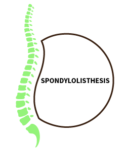 Spondylilosthesis can cause sciatica