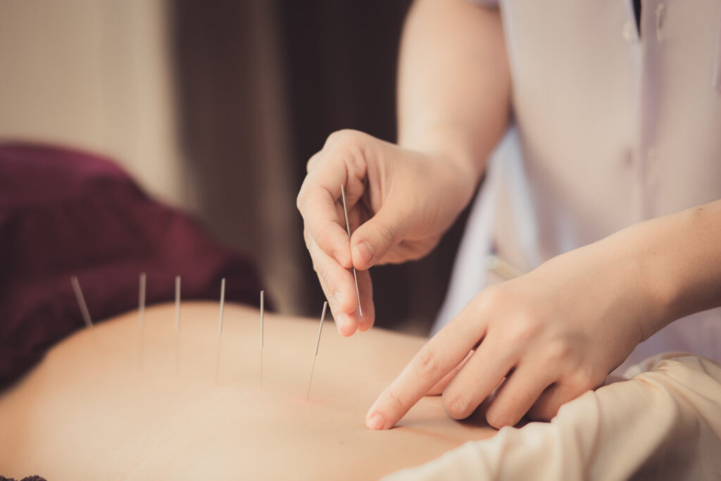 Acupuncture Shutterstock image Acupuncture Manual low force soft tissue treatment